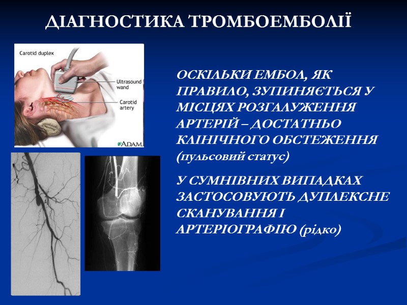 ДІАГНОСТИКА ТРОМБОЕМБОЛІЇ ОСКІЛЬКИ ЕМБОЛ, ЯК ПРАВИЛО, ЗУПИНЯЄТЬСЯ У МІСЦЯХ РОЗГАЛУЖЕННЯ АРТЕРІЙ – ДОСТАТНЬО ДІАГНОСТИКА ТРОМБОЕМБОЛІЇ ОСКІЛЬКИ ЕМБОЛ, ЯК ПРАВИЛО, ЗУПИНЯЄТЬСЯ У МІСЦЯХ РОЗГАЛУЖЕННЯ АРТЕРІЙ – ДОСТАТНЬО